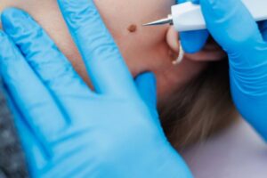 How to Tell if a Mole Needs Medical Attention or Removal